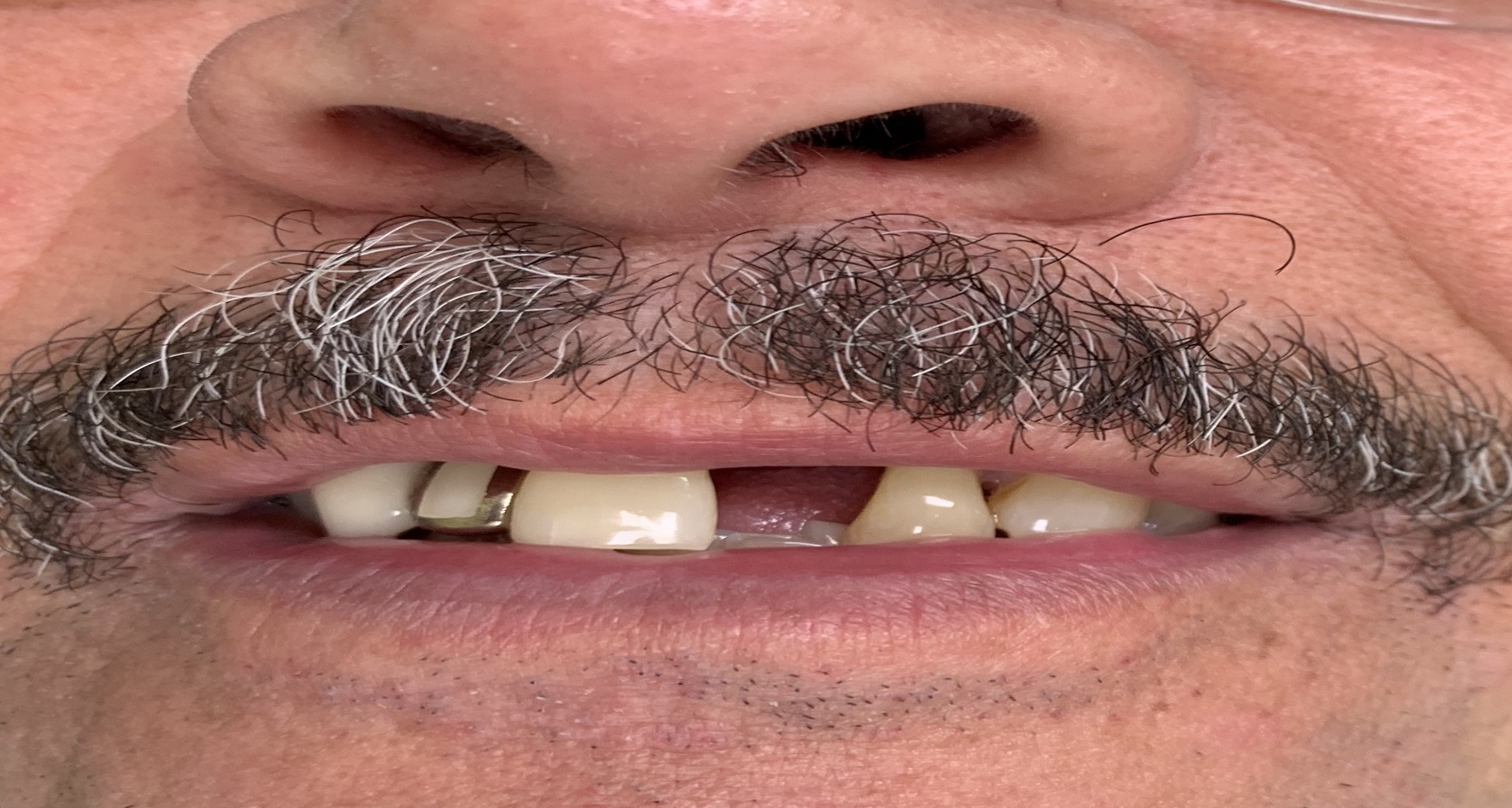 Photo of Before and After Implants 3