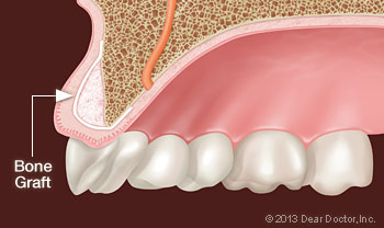 Photo of Bone Grafting