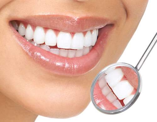 Photo of Bonding and White Fillings