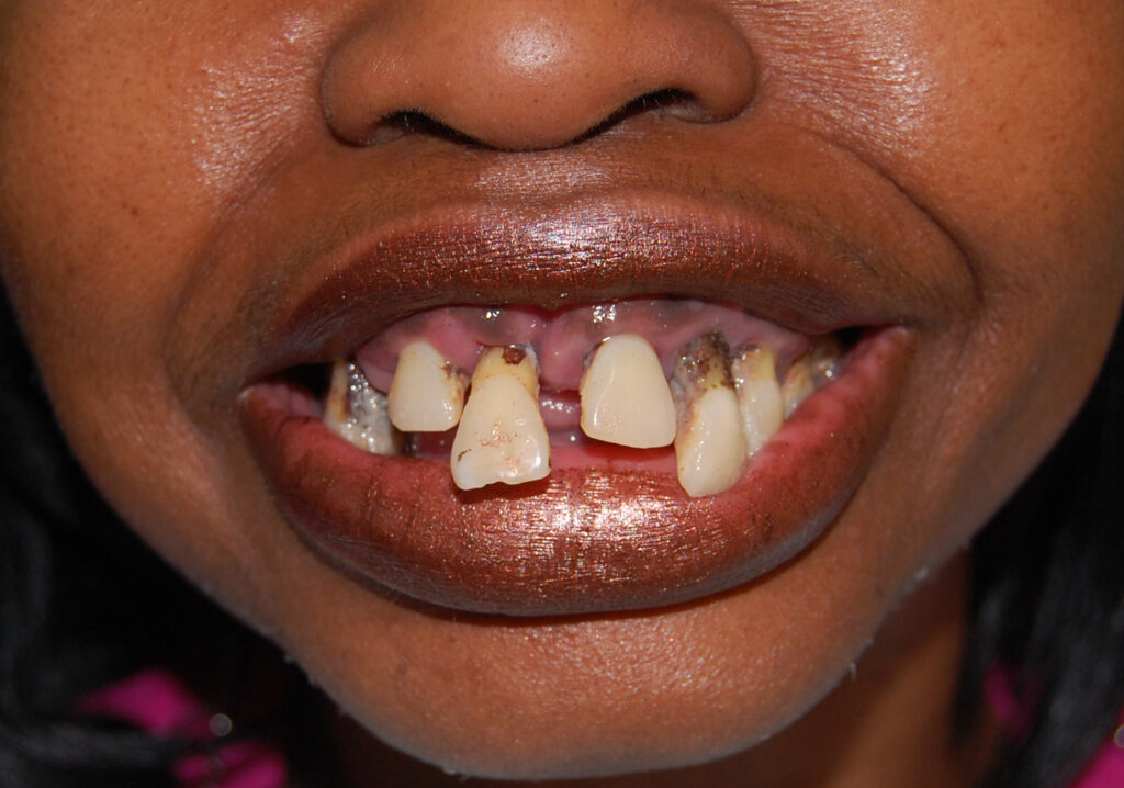 Photo of Before and After Implants 3