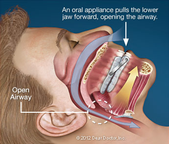 Photo of Sleep Apnea